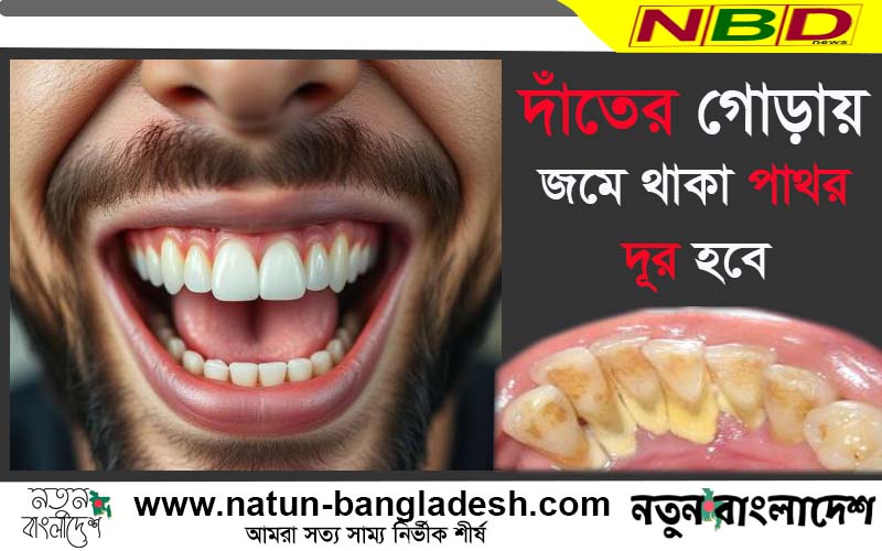দাঁতের গোড়ায় জমে থাকা পাথর দূর করুন
